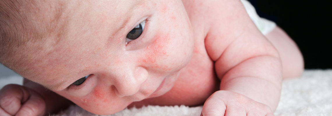 regisseur niets boom Baby acne: wat is het en wat kan je eraan doen? | Negenmaandenbeurs |  Negenmaandenbeurs